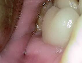 Trotz suboptimaler Mundhygiene im lingualen Bereich ist die Gingiva im Bereich der Implantatversorgung entzündungsfrei.