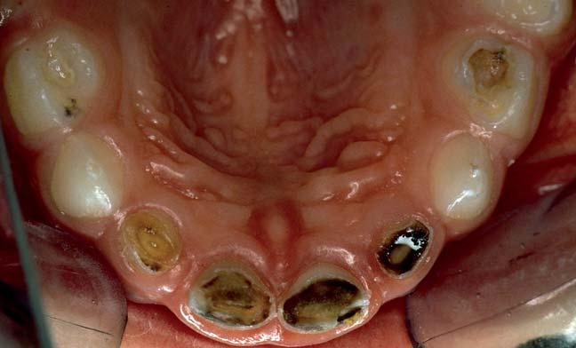 Wie wirkt Fluorid an der Zahnoberfläche? Die ständige Verfügbarkeit von Fluoridionen auf der Schmelz- und Dentinoberfläche während der De- und Remineralisation wirkt kariespräventiv.