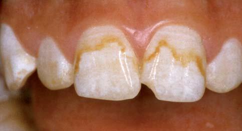 1: Risikofenster zur Entwicklung einer Dentalfluorose an bleibenden Zähnen. minderte Entwicklung der Intelligenz erhöht sind.