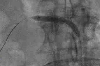 IN-STENT