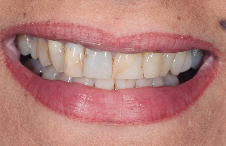 Das klinische Hauptproblem der Patientin waren die vielen von Karies befallenen Zähne und die durch food-impact bedingte