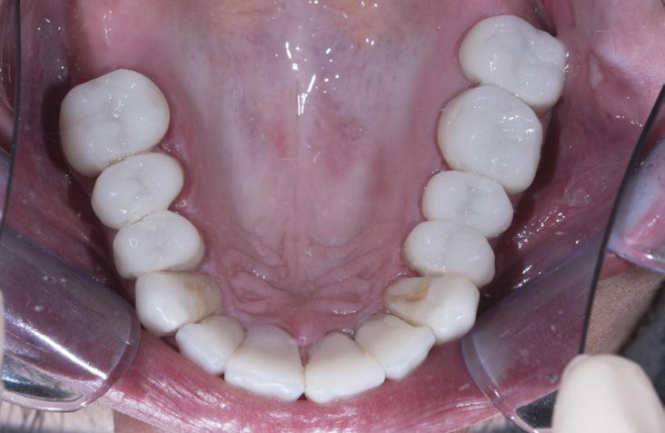 Beinahe alle Zähne waren wurzelbehandelt, außer 13 und 23.