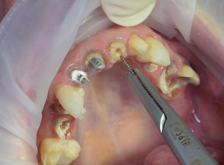 Zahnrekonstruktionen 2 Entfernen