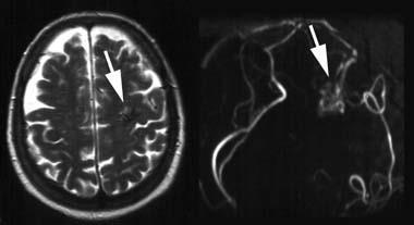 Abbildung 7 Eine Hirngefäßmissbildung (kernspintomographische Aufnahmen). und im Vergleich dazu das Behandlungsrisiko ist.
