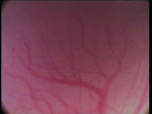 Was ist Morbus Osler? Morbus Rendu-Osler-Weber oder hereditäre hämorrhagische Teleangiektasie kurz HHT genannt ist eine seltene, erbliche Erkrankung der Blutgefäße und des umliegenden Gewebes.