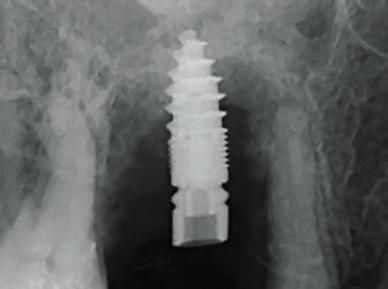 Ob die vestibuläre Knochenwand nun 0,4 oder mit 1,2 mm zu messen war, spielt nach einer prospektiven Studie zur Sofortimplantation keine Rolle.