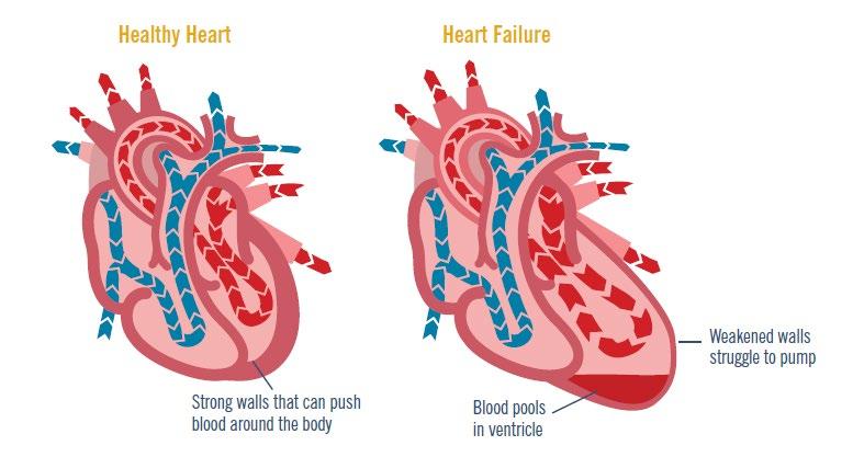 So verändert sich das Herz mit Herzinsuffizienz Gesundes Herz Krankes Herz Geschwächte Wand Kräftige Wand Blut sammelt sich in der Herzkammer Bei einer Herzinsuffizienz mit reduzierter