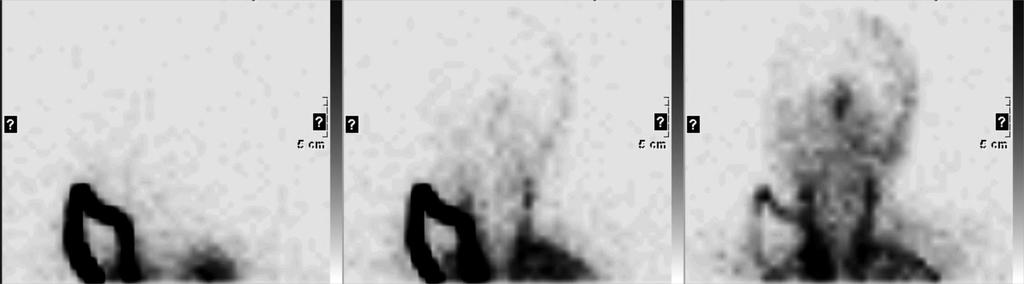 Hirnperfusions-Szintigraphie 1.