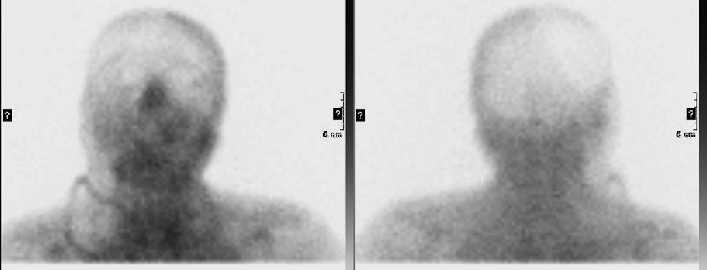 Hirnperfusions-Szintigraphie 2.