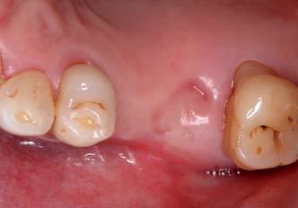 Quadranten gestellt. Chirurgische Führungsschablonen wurden auf der Basis einer drei - dimensionalen Röntgendiagnostik mittels DVT zwölf Wochen nach der Entfernung des Zahnes 16 gefertigt.