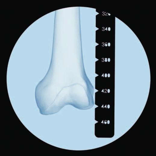 Antegrader Zugang Proximales Femur eröffnen Den Bildverstärker zum distalen Femur schieben, das proximale Ende der Messlehre an die markierte Hautstelle bringen und eine AP-Röntgenaufnahme des
