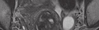 Die Indikation zur Operation stellt sich in diesen Fällen ähnlich wie beim Myom (endometriumnah, Grösse > 2 cm).