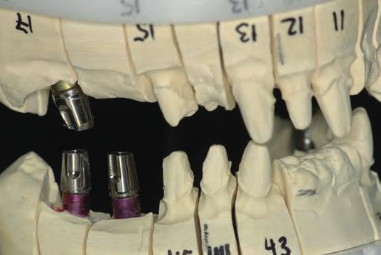 fehlenden Stützzonen mit Implantaten in regio 17, 24, 25, 26, 36, 46 und 47 versorgt