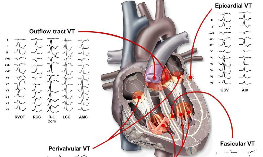 Ventrikuläre Extrasystolen Kardiologie 1. Prognose der Patienten mit VES 2. VES ohne strukturelle Herzerkrankung 3. Behandlung: Antiarrhythmika vs.