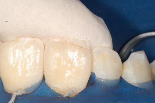 Eine entsprechende Anpassung der Schichttechnik erfolgt grundsätzlich nach dem Applizieren und Polymerisieren der Dentinmasse (Abb. 12, 13, 14, 15, 16, 17).