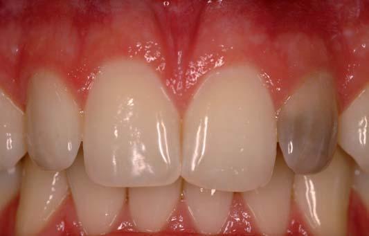 I Fachbeitrag _ Bleaching Abb. 1 Abb. 2 Abb. 1_ Ausgangsbild der Patientin. Sie ist unzufrieden mit ihrer Zahnfarbe an 22. Abb. 2_Situation nach internem Bleaching. gen aufnehmen.