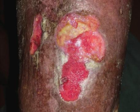 positivem MRSA/VRE-Befund Irrititierte Haut (Akne etc.
