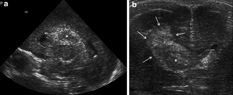 Abb. 8 a, b Sonographische Darstellung einer massiven Ventrikelausgussblutung im parasagittalen Längsschnitt bei einem extrem unreifen Fr uhgeborenen (a Grad 3) sowie einer Ventrikelblutung mit