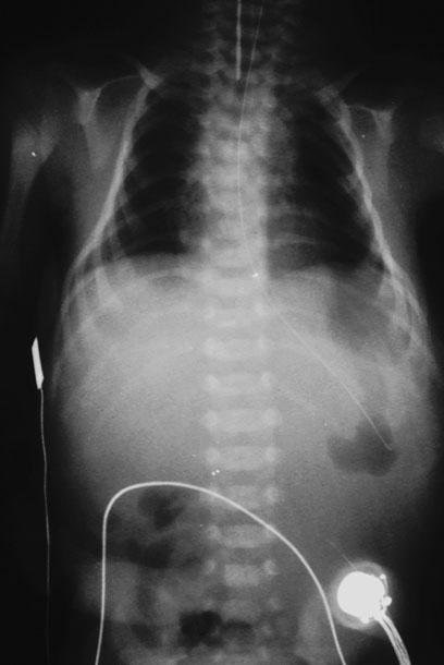 Abb. 12 Radiologischer Befund einer ätiologisch ungeklärten Lungenhypoplasie bei einem Fr uhgeborenen der 34.