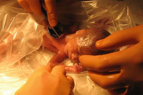 Abb. 3 Erstversorgung eines Fr uhgeborenen unter einem Wärmestrahler in einem Plastiksack Abtrocknen Stimulation Absaugen Stufe 1 Stufe 2 Stufe 3 Hautfarbe Hautfarbe Puls Hautfarbe Puls Zyanotisch?