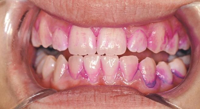 206 April 2018 4 Kariesprophylaxe bei Kindern bis zum 6. Lebensjahr Abb. 2 Patientin mit angefärbten Zähnen. Die Beläge sind insbesondere in den Zwischenräumen zu erkennen. Abb. 3 Beläge auf der Kaufläche eines durchbrechenden Zahnes.