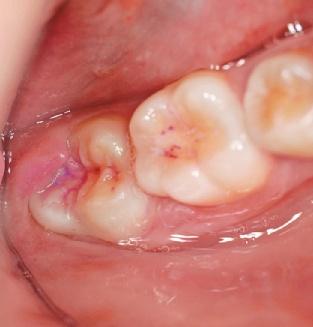 Da die Fluoride ihre schützende Wirkung auf der Zahnoberfläche ausüben, müssen sie regelmäßig in den Mund eingebracht werden. Am sinnvollsten geschieht dies durch den Patienten selbst.