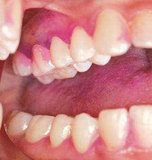 Die Wirkung von Fluoridtabletten ist gegenüber Zahnpasten, die ja direkt am Zahn wirken, geringer. Bei Kleinkindern bis etwa zum 6.