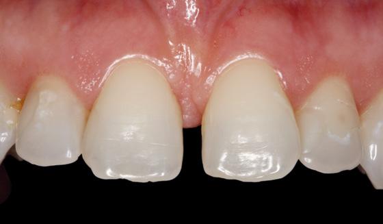 Dentinfarben mit niedriger Transluzenz zur Verfügung.