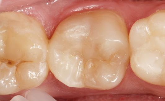 A2 Dentin und Tetric EvoCeram A2 Quelle: Dr.