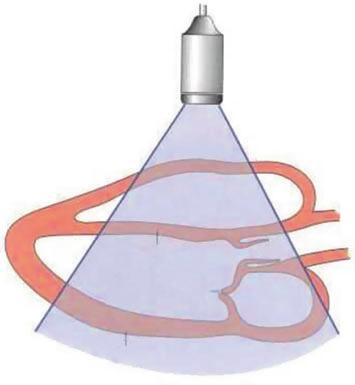 3 RV SE LV MV PW Abb. 1 Parasternaler Langachsenschnitt AV rechte Schulter anguliert, sodass die Herzbasis abgebildet wird.
