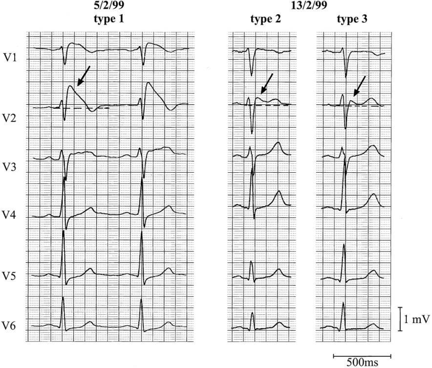 langes QT-Syndrom Ruhe-EKG: Risikomarker Akute Ischämiezeichen