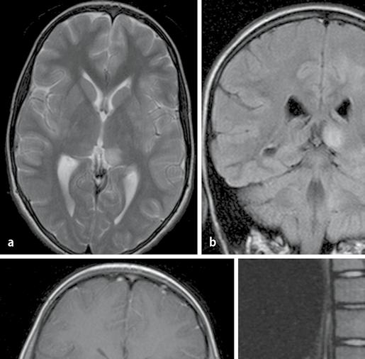 Abb. 3 8 ADEM mit Thalamusläsion und spinalem Herd; 12-jähriges Mädchen mit Nachweis einer Signalsteigerung im Thalamus links (a, b). Weitere kleine Läsion rechts mesenzephal (c).