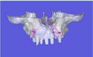 2007) auf einem einzigartigen Niveau, mit dem für implantatgestützten ZE außerordentlich positiven Ergebnis,