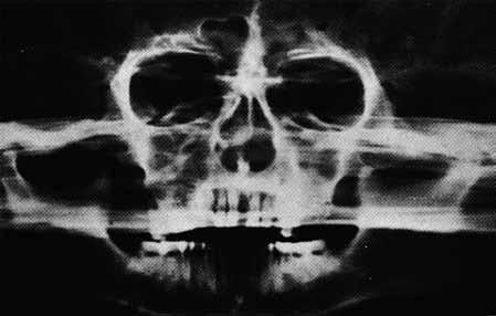 Praxis des zahnärztlichen Röntgens Während Zulauf, Numata und Paatero sich auf die Panoramadarstellung der Zähne konzentrierten, stellte der Radiologe Heckmann 13 ein Verfahren vor, mit dem er die