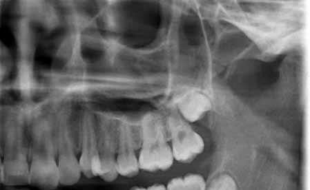 Damit gelang ein entscheidender Schritt in Richtung zur 3-dimensionalen Bildgebung, so wie wir sie jetzt mit der dentalen Volumentomografie als Nachfolger der konventionellen Tomografie im