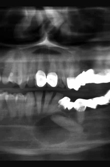 Praxis des zahnärztlichen Röntgens Abbildung einzelner Kieferabschnitte Es erscheint durchaus sinnvoll, bei gezielten Fragestellungen nicht immer ein gesamtes OPG anzufertigen, sondern nur den