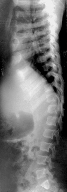 Abb. 3 Achondroplasie (6 Jahre). Anterior-posterior verk urzte Wirbelkörper mit verstärkter dorsaler Konkavität, enger Wirbelkanal, anterior aufgetriebene Rippenenden.