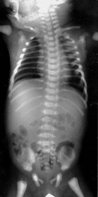 Abb. 11 Osteopetrose (Neugeborenes).