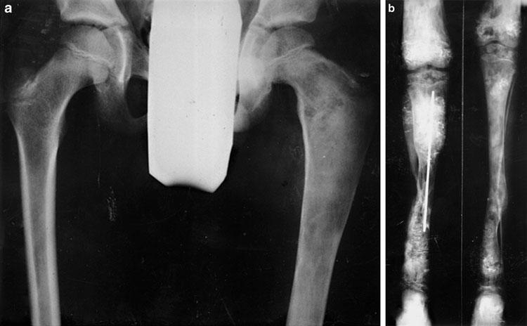 Abb. 14 a, b Fibröse Dysplasie. a Vorwiegend lytische Herde im linken Oberschenkel. Sklerotischer Herd im linken Os pubis.