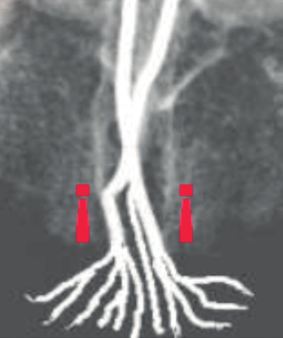 7: Schematischer Verlauf der Gefäßarkade zwischen der A. nasopalatina (A. n., im Bild ist die linke Arterie dargestellt) und der A. palatina major (A. p. m.). Beide Arterien entstammen dem Stromgebiet der A.