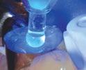 UltraTect Schutzbrillen Schützen ideal vor dem von zahnmedizinischen Polymerisationsleuchten