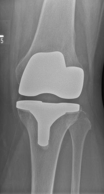 Endoprothetik am Kniegelenk: In Abhängigkeit vom Ausmaß des Gelenksverschleißes stehen uns eine Vielzahl