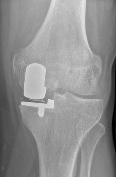 Ist nur der innere oder äußere Anteil der Kniegelenksknorpelflächen verschlissen (Schmerzen nur auf der Knieinnen-, oder außenseite) kann bei intakter Bandfunktion ein Teilgelenksersatz als
