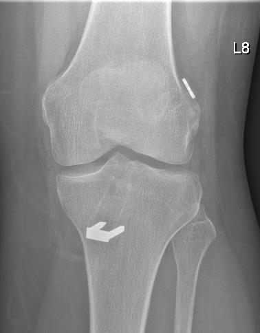 Arthroskopische Operationen am Kniegelenk: Eine Vielzahl von gelenkerhaltenden Eingriffen am Kniegelenk können mit Unterstützung der Arthroskopie (Gelenkspiegelung) behandelt werden.