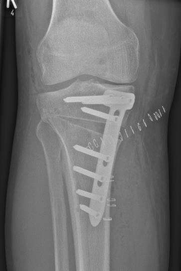 Weitere arthroskopische Operationen am Knie sind: Probengewinnung bei Verdacht auf entzündliche, ggf.