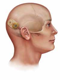 Magnetresonanztomographie (MRT) bei Personen mit HiRes 90K und HiRes 90K ADVANTAGE Cochlea-Implantate 2.