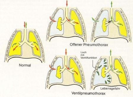Definition Als Hämatothorax wird eine Blutansammlung zwischen Pleura parietalis und Pleura visceralis