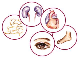 Diabetes mellitus