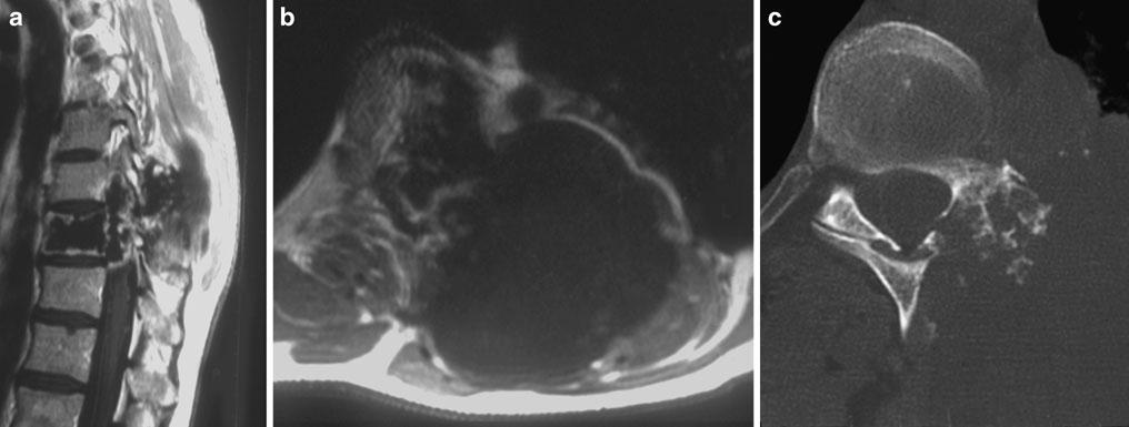 Knochenfenster (c) weisen das Ausmaß der knöchernen Destruktion aus, die auf einen malignen Tumor hindeutet. Die histologische Diagnose lautete Chordom. (Aus Klekamp und Samii 2007) Abb.