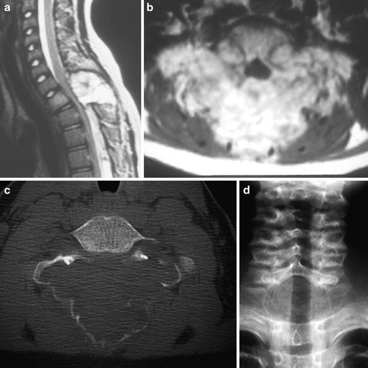 Spinale Tumoren 21 Abb. 16 a-d 11-jähriger Junge mit lokalen Schmerzen im zervikothorakalen Übergang ohne Neurologie.